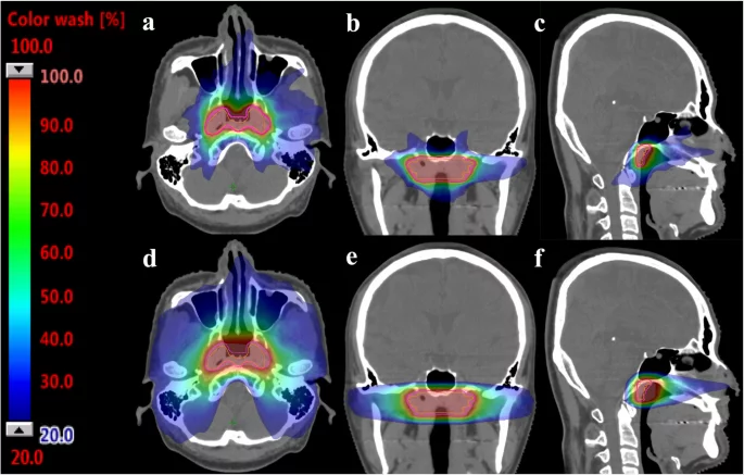 Proton therapy for nasopharyngeal cancer