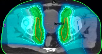 Proton therapy is an effective treatment for prostate cancer